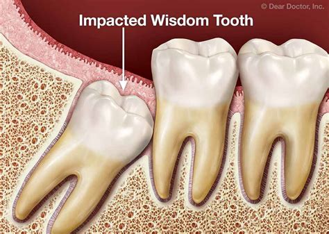 You should visit your dentist as soon as you suspect them emerging to see if they need to be removed. . Wisdom teeth removal impact on brain
